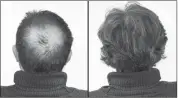  ??  ?? Breakthrou­gh research proves this discovery helps fill-in bald spots, re-nournishes thinning hair, and leads to noticeable growth in as little as 30 days.