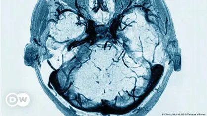  ??  ?? That's how a thrombosis looks in a CT