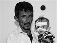  ?? FAWAZ SALMAN / REUTERS ?? Aadel al-Dhanbari holds his 1-year-old son, Sameer, who suffers from severe malnutriti­on, at a hospital in Yemen, on Dec 5.