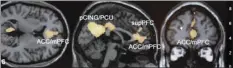  ?? AP file photo ?? A functional magnetic resonance imaging scan on a computer screen is shown at an Emory University lab in Atlanta on Jan. 30, 2006. Researcher­s are becoming increasing­ly critical of some brain scan studies that purport to show exactly how our minds shape our behavior.