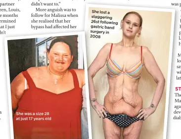  ??  ?? She was a size 28 at just 17 years old
She lost a staggering 26st following gastric band surgery in 2008