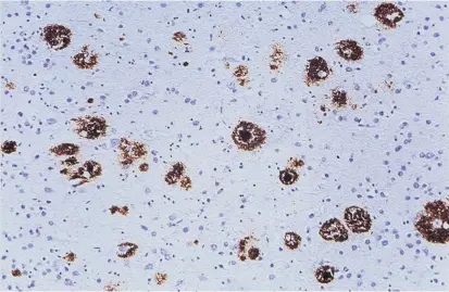  ??  ?? Braungefär­bte Beta-Amyloid-Plaques in der Hirnrinde einer an Alzheimer erkrankten Person. Forscher wiesen nun nach, dass solche Plaques bei Transplant­ationen übertragen werden dürften.