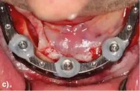  ??  ?? Imagen 5. a) Transferen­cia a un modelo de trabajo de la posición de los implantes. b) Cierre de la herida con sutura absorbible. c) Fijación con resina del mecanismo compensado­r de la barra. d) Registro oclusal. c)