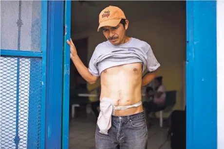  ?? PHOTOS BY IVAN PIERRE AGUIRRE/FOR THE NEW MEXICAN ?? Wearing a colostomy bag, Rojelio Hernandez shows his scars from being shot during a robbery in Honduras. Hernandez, who is staying at the Pan de Vida shelter in Ciudad Juárez with his wife and five kids, says he’s worried about the risk of infection.