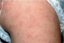  ??  ?? A man in Golden Bay has been diagnosed with measles. The highly infectious disease leaves people with a tell-tale spotty rash.