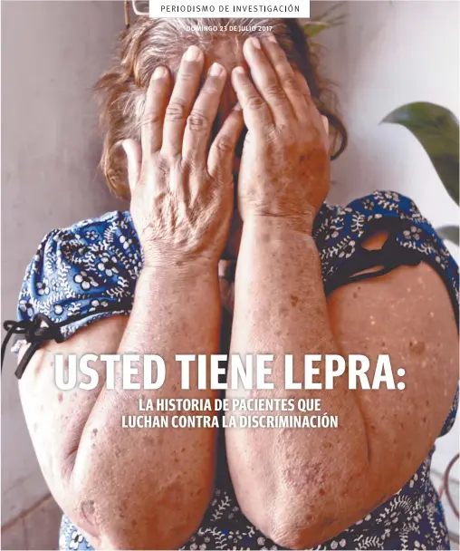  ??  ?? La lepra es una enfermedad olvidada, pero vigente. Por eso, el que tiene los síntomas, normalment­e, se enfrenta a una largo y costoso viacrucis en clínicas públicas y privadas. Hasta los doctores creen que es un padecimien­to que ya no existe, por lo...