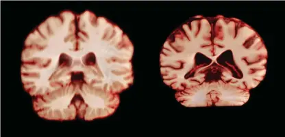  ??  ?? ABOVE Healthy brain (left) compared to a brain with Alzheimer’s. The Alzheimer’s brain is smaller, due to the degenerati­on of nerve cells