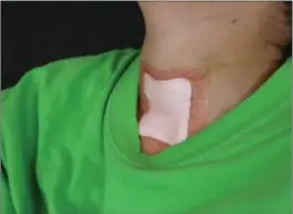  ??  ?? Et stort plaster dekker området foran på halsen hvor det ble utført trakeotomi på Esteban Aleksander (12). Trakeotomi er et kirurgisk inngrep hvor en tube eller kanyle føres inn i luftrøret.