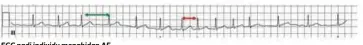  ??  ?? ECG nadi individu menghidap AF.