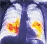  ??  ?? DISEASE Lung cancer X-ray