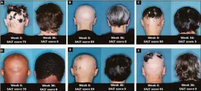  ?? Contribute­d photo ?? Patients with alopecia areata before and after 36 weeks of treatment with baricitini­b.