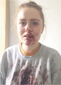  ??  ?? Saoirse Smith showed her injuries in a Facebook post