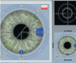  ?? LENSAR ?? Präzise und sichere 3-D-Steuerung des Femto-Lasers.