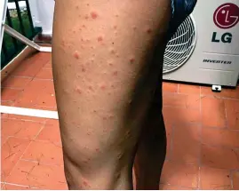  ??  ?? Painful: Miss Docherty’s leg is covered in bites from bed bugs