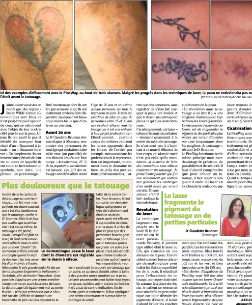  ?? (Photos Eric Bernstein/Arielle Kauvar/Ax.T. et DR) ?? Le dermatolog­ue passe le laser dont le diamètre est réglable sur le dessin à effacer.