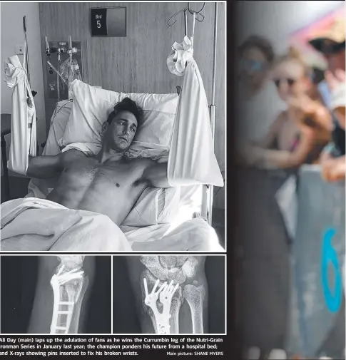  ??  ?? Ali Day (main) laps up the adulation of fans as he wins the Currumbin leg of the Nutri-Grain Ironman Series in January last year; the champion ponders his future from a hospital bed; and X-rays showing pins inserted to fix his broken wrists. Main picture: SHANE MYERS