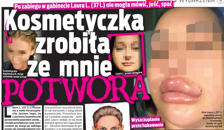  ??  ?? Kosmetyczk­a Agnieszka N. wciąż zachwala swoje usługi
Laura L. przed zabiegiem
Usta Laury L. (37 l.) napuchły, urosły do monstrualn­ych rozmiarów. Każdy ich ruch wywoływał ból