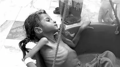  ??  ?? A severely malnourish­ed girl is weighed at the Aslam health center in Hajjah in Yemen. (Photo: Getty Images)