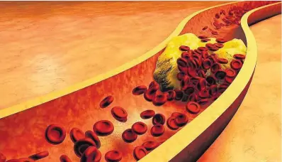  ??  ?? Zu viel „schlechtes“Cholesteri­n im Blut schädigt die Gefäße und gefährdet das Herz