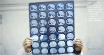  ?? — Reuters ?? Cancer patient Cao Dongxian poses with CT scan images of his intestine at a hotel room where he stays, near the Peking Union hospital, during an interview in Beijing.