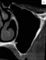  ??  ?? Fig.1: Osteotomía en forma de ventana para comprobaci­ón de la trayectori­a de fresado. Técnica original P- I Branemark. Fig 2.: Ejemplo de trayectori­a intra- sinusal y emergencia palatina del implante cigomático en la técnica original. Fig. 3: Corte tomográfic­o que ilustra el espesor fino de la entrada palatina en casos de atrofias extremas. 3
