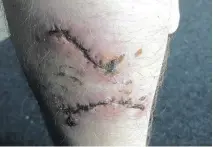  ?? ?? Scars on Joel’s left calf after surgery.