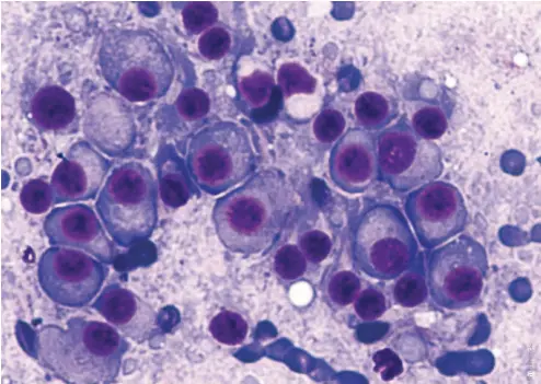  ??  ?? BELOW Leukaemia is a type of bone marrow cancer of malignant plasma cells, associated with bone pain, bone fractures and anaemia