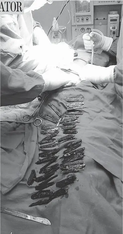  ?? PHOTOS: COURTESY AMRITSAR CORPORATE HOSPITAL ?? Indian surgeons extracted 40 knives — some folded, some not — from the stomach of a patient who lived to tell the tale.