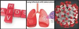  ?? [File Picture] ?? Caption: A picture collage showcasing the HIV, TB and COVID-19 co-infection.