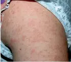  ??  ?? The red, blotchy skin rash of a measles patient.