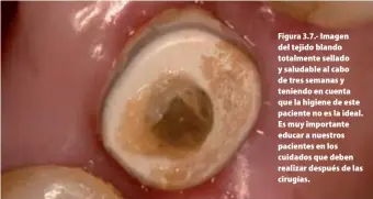  ??  ?? Figura 3.7.- Imagen del tejido blando totalmente sellado y saludable al cabo de tres semanas y teniendo en cuenta que la higiene de este paciente no es la ideal. Es muy importante educar a nuestros pacientes en los cuidados que deben realizar después...