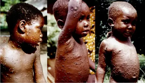  ?? WHO /Mark V. Szczeniows­ki ?? A 7-year-old Zairian girl with monkeypox in the acute stage, day 7 of rash, and monkeypox in a 3-year-old Zairian boy with rash in the scabbing stage, DRC, 1970-1977.