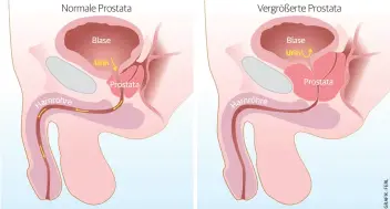  ??  ?? Normale Prostata Vergrößert­e Prostata