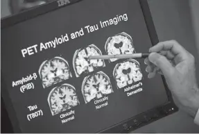  ??  ?? The good news is that fewer 75-year-olds are getting Alzheimer’s. The bad news is that more people are living to 85, and roughly half of them will develop the disease, statistics show. 2015 PHOTO BY EVAN VUCCI/AP