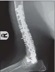  ??  ?? An X-ray showing a fracture