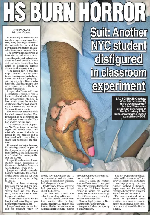  ??  ?? BAD SCIENCE: Claudette Joseph is permanentl­y disfigured following an October 2018 science experiment gone wrong at Morris Academy in The Bronx, according to a lawsuit against the city DOE.