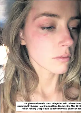  ??  ?? > A picture shown in court of injuries said to have been sustained by Amber Heard in an alleged incident in May 2016 when Johnny Depp is said to have thrown a phone at her