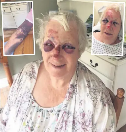  ??  ?? Jeanette Turpin shows the injuries she suffered following a fall at home, which included cuts and bruises to her arm, wrist and face. The 81-year-old had to wait more than two-and-a-half hours for an ambulance and has since made a formal complaint.