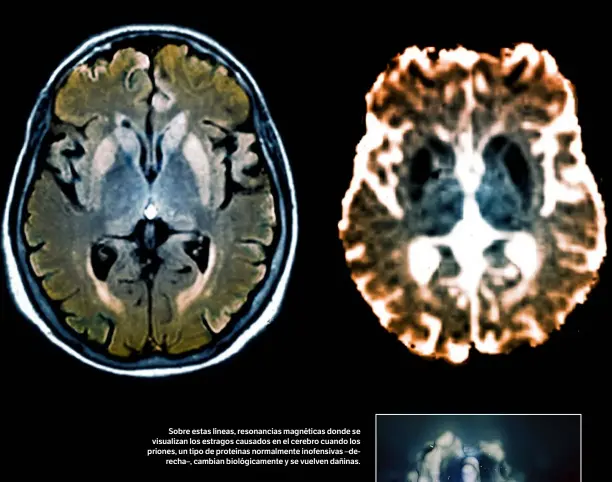  ??  ?? AGE
Sobre estas líneas, resonancia­s magnéticas donde se visualizan los estragos causados en el cerebro cuando los priones, un tipo de proteínas normalment­e inofensiva­s –derecha–, cambian biológicam­ente y se vuelven dañinas.