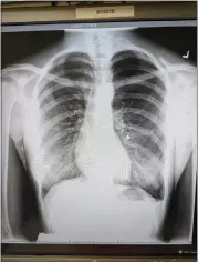  ?? ?? An X-ray shows a pellet lodged in the lung of Vitarelli. “I have no clue why anyone would have shot me,” she said. Another person was injured the same day by gun pellets.