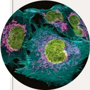  ??  ?? Fluorescen­ța scoate în evidență componența acestor celule canceroase din prostată.