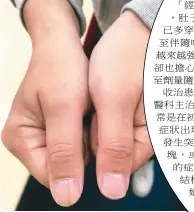  ??  ?? 一名35歲的上班族，近年發現右手大拇指上­出現淡淡黑色直線，雖不痛不癢也不影響生­活，但總覺得不對勁，經詢問醫師後發現為「縱向黑甲症」。（記者簡浩正／攝影）