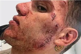  ??  ?? In the wars: Ederson required eight stitches to his face