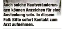  ?? ?? Auch solche Hautveränd­erungen können Anzeichen für eine Ansteckung sein. In diesem Fall: Bitte sofort Kontakt zum Arzt aufnehmen.