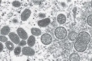  ?? The Associated Press ?? ■ This 2003 electron microscope image made available by the Centers for Disease Control and Prevention shows mature, oval-shaped monkeypox virions, left, and spherical immature virions, right, obtained from a sample of human skin associated with the 2003 prairie dog outbreak. The spread of monkeypox in the U.S. in 2022 could represent the dawn of a new sexually transmitte­d disease, or it could yet be contained. Or it might be too early to tell.