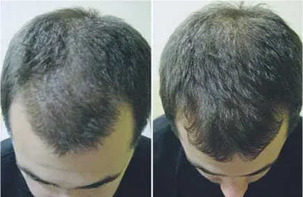  ??  ?? Varón de 33 años. Alopecia androgenét­ica grado II de Ebling. Mejoría notable tras 3 sesiones (a los 5 meses) de tratamient­o con factores de crecimient­o del plasma