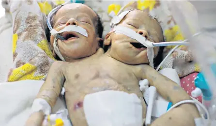  ??  ?? Abdelkhale­q and Abdelkarim were born two weeks ago in Sanaa, Yemen’s capital. A doctor on the case says they require treatment outside the war-torn country