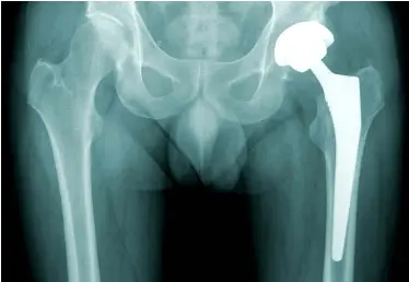  ?? PHOTO: © SKYHAWK911 | DREAMSTIME.COM ?? Surgical Implant:
X-ray of a hip replacemen­t