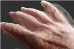  ?? ?? Early symptoms of Parkinson’s include tremors in the hands