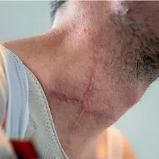 ?? PHOTO: ALDEN WILLIAMS/FAIRFAX NZ ?? The scars are permanent reminders of how close Keagan Girdleston­e came to losing his life after crashing through the back window of his support car.